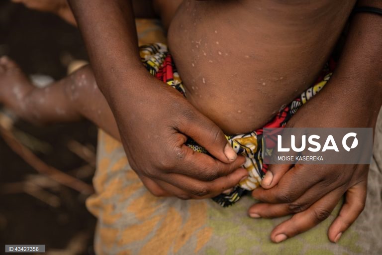 Cabo Delgado regista primeiro caso de mpox e eleva total para 70 em Mo?ambique